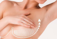 Операция по подтяжке груди (мастопексия)