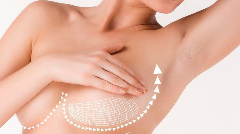 Операция по подтяжке груди (мастопексия)