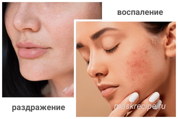 воспаления и раздражения кожи